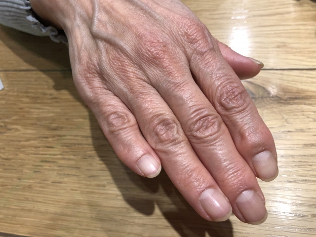 指のこわばりとは