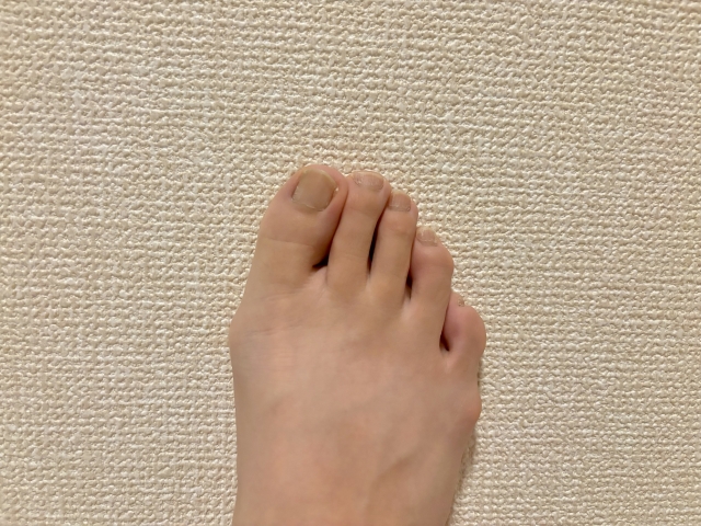 種子骨障害とは