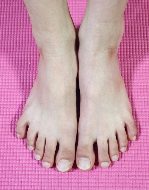 踵骨骨端症とは