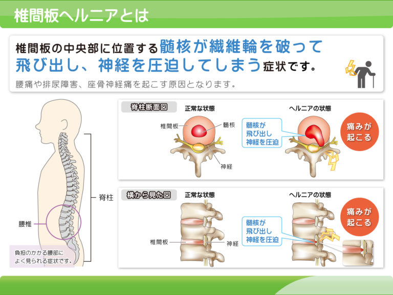 腰椎椎間板ヘルニアは一生付き合うしかないのか？ 福岡県春日市の整骨院『整骨院ふじた』【公式サイト】